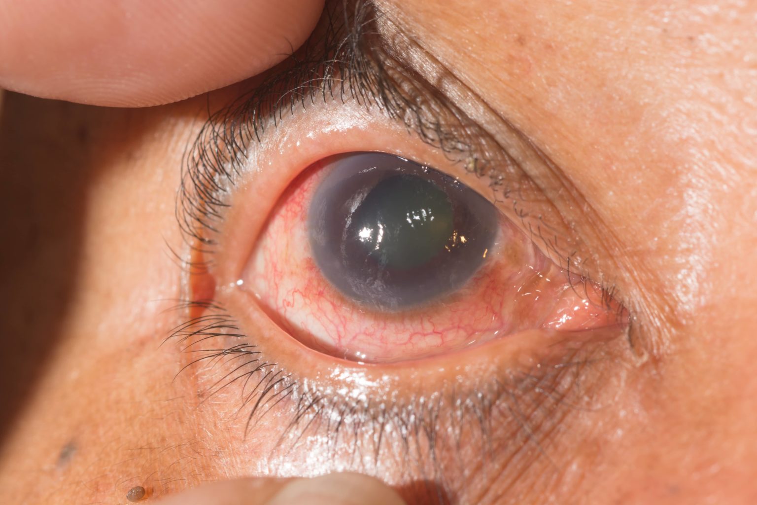 Glaucoma Glaucoma Treatment in Pune