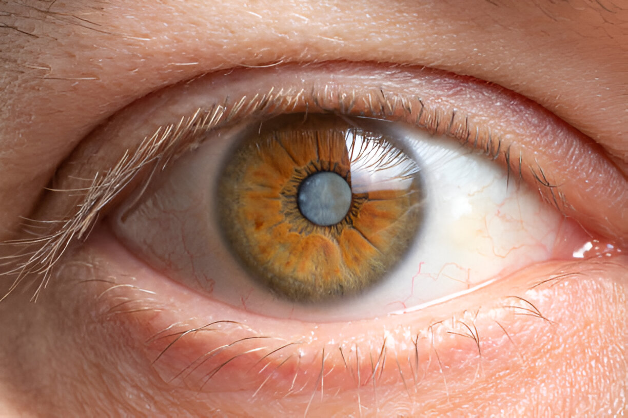 Cataract Symptoms Cataract Symptoms