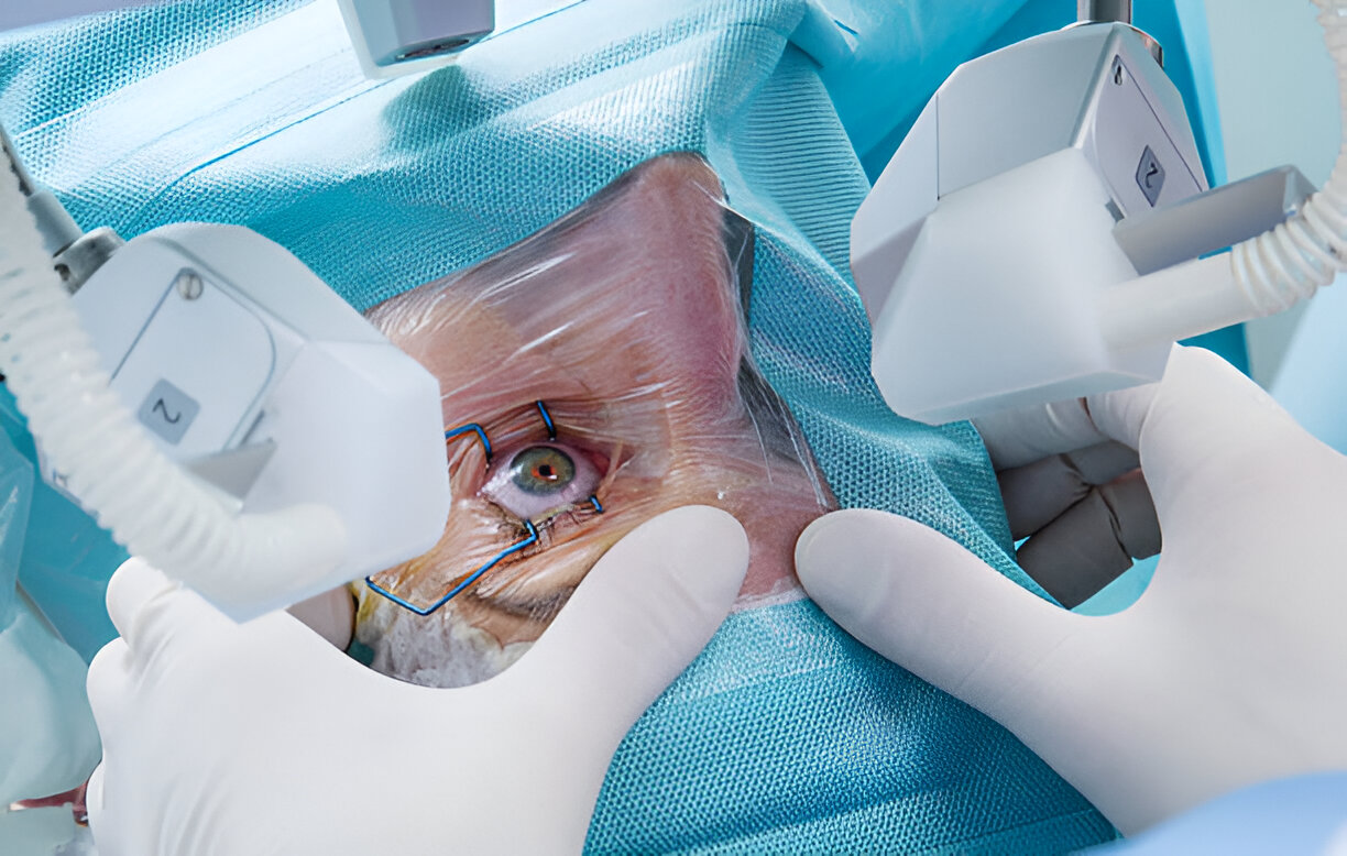 Cataract Cataract Surgery