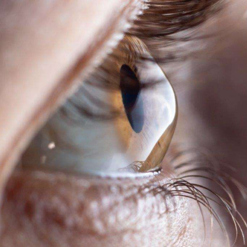 Keratoconus Treatment
