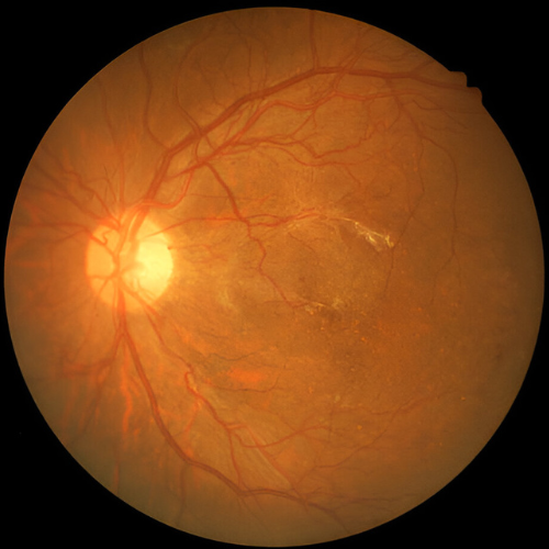 Technique of Laser Therapy for Diabetic Retinopathy