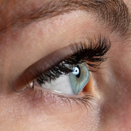 Keratoconus? Keratoconus