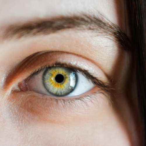 Glaucoma Glaucoma
