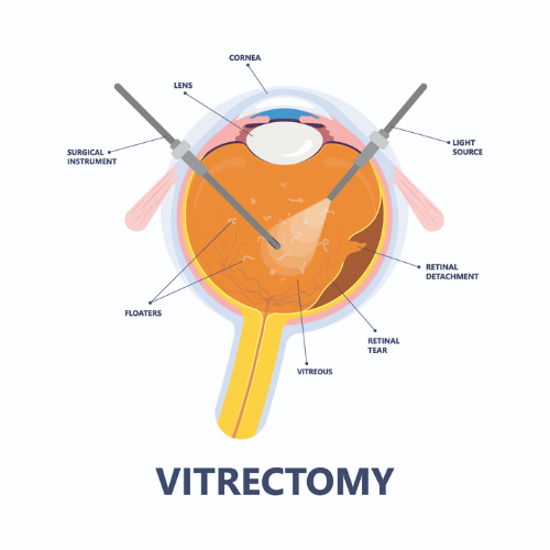 Vitrectomy