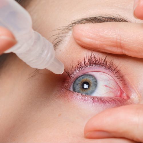 Dry Eye Treatment at Motewar Netralaya, Nanded