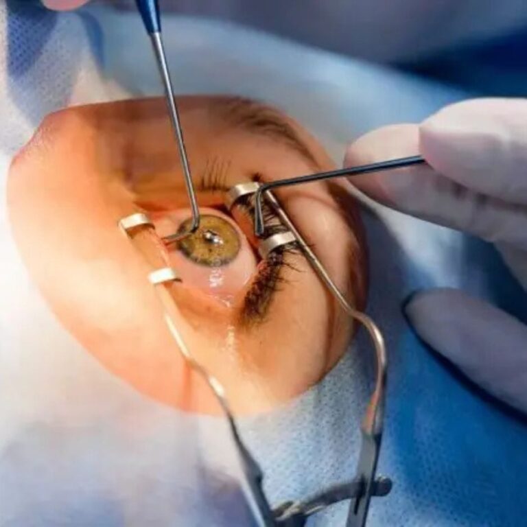 Intraocular Lens (IOL) Surgery