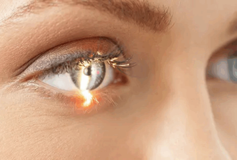 Motewar Netralaya for Femto LASIK