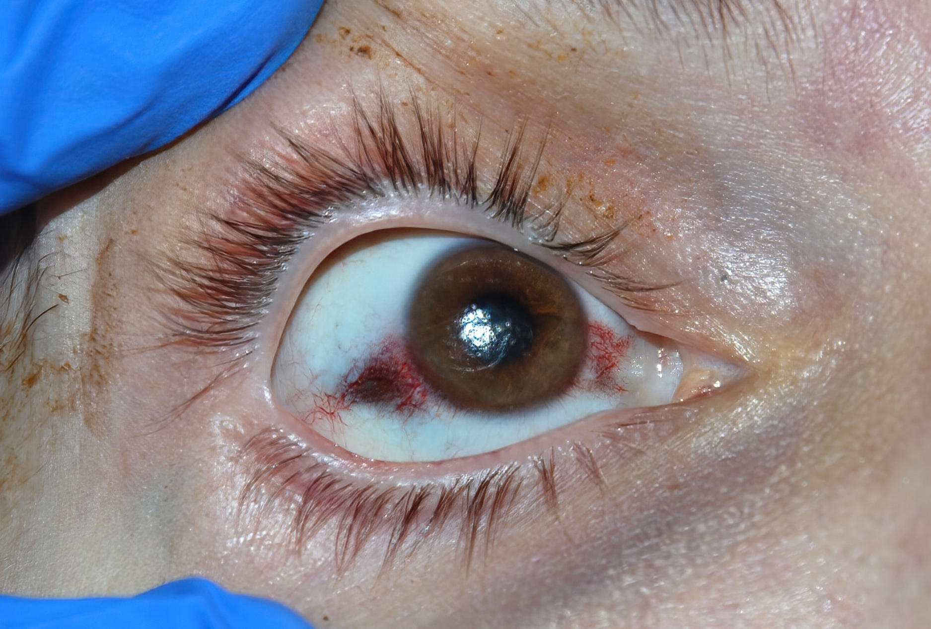 Pterygium Surgery(2) Pterygium Surgery(2)