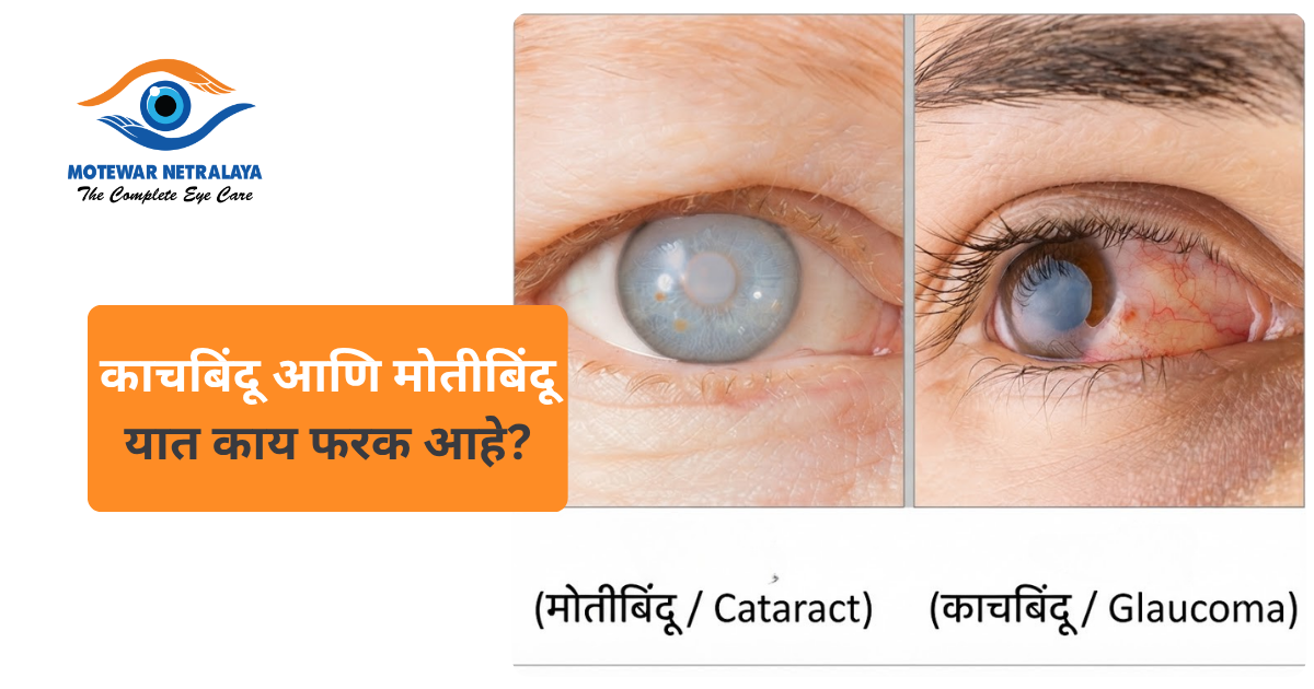 काचबिंदू आणि मोतीबिंदू यात काय फरक आहे?